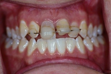 dental-crowns-1